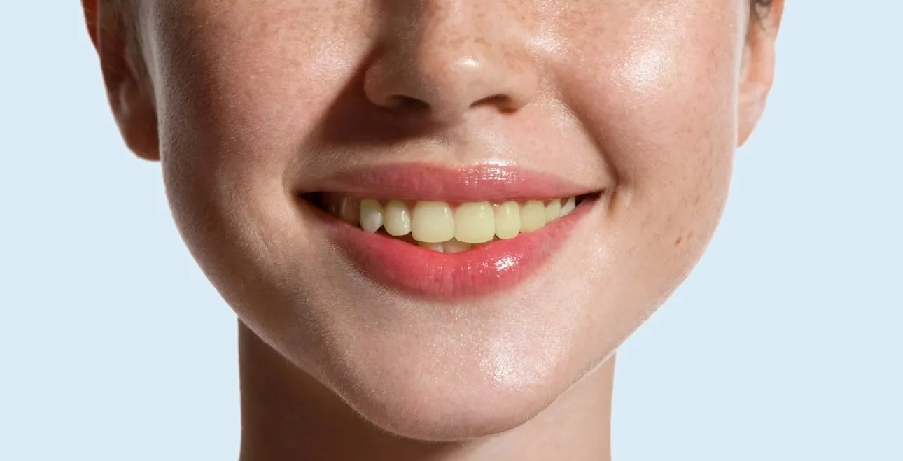 Primer plano de la misma sonrisa con los dientes amarillentos, antes del blanqueamiento dental (imagen ilustrativa)